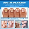 thumbnail image 4 of Para El Cuidado Las Uñas Reparadora Herramientas Indoloras Antihongos Onicomicosis, 4 of 9