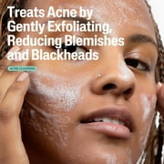 Cetaphil Gentle Clear Pore Clearing Acne Cleanser for Sensitive, Acne-Prone Skin, 8 fl oz