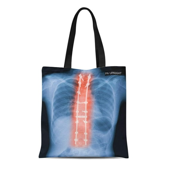 KDAGR Canvas Tote Bag X Ray of Adult Patient Spine Show Scoliosis Surgery Durable Reusable Shopping Shoulder Grocery Bag