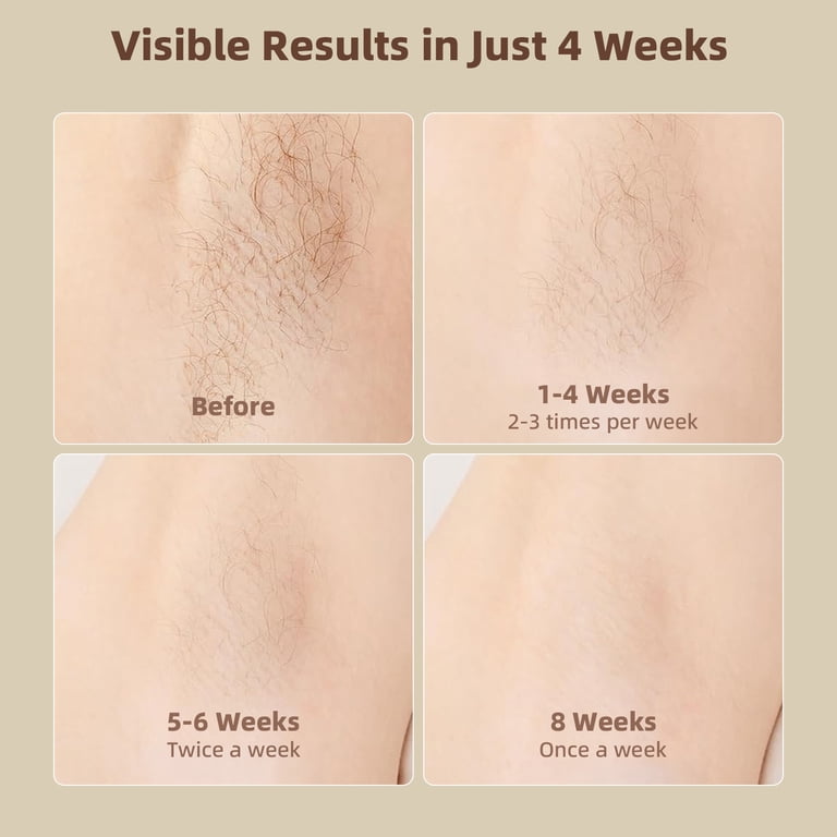 Velsolare 脱毛器 200K Shots DARZU Laser Hair Removal Device, 999,999 Flashes, Facial and Body