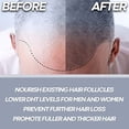 FoliTonic Advanced DHT Blocker To Stop Hair Loss, Hair Thinning & Help