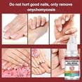 thumbnail image 3 of Esmalte de uñas, Tratamiento para hongos en las uñas de los pies extra fuerte, Tratamiento para hongos en las uñas de los pies, Tratamiento para hongos en las uñas de los pies,, 3 of 4