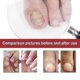 thumbnail image 2 of Nail Treatment Solution For Crooked Nails, Soft Nails, Thickened Nails, Unwell Nails And Gra, 2 of 4