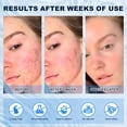 thumbnail image 4 of Crema de ácido azelaico Marianp 10% para acné facial rosácea 30 ml, 4 of 7