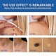 thumbnail image 3 of ZHAOCHENG Crema para eliminar verrugas y lunares, 50 g, 3 of 5
