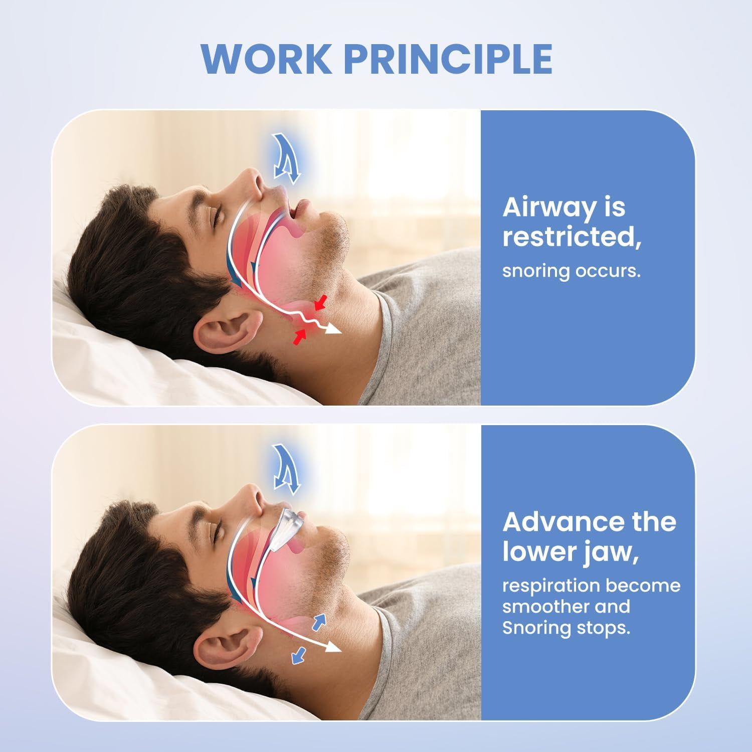 Anti-Snore Device for Stop Snoring Solution,  Anti Snoring Mouthpiece Mouth Guard for Men and Women