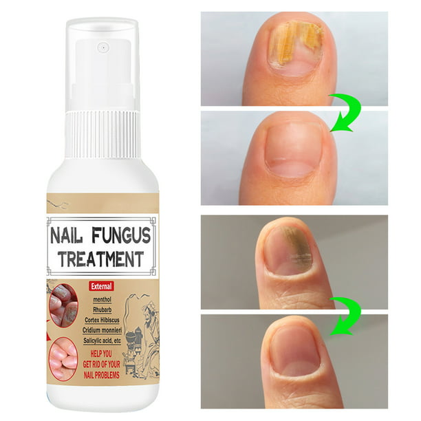 Tea Tree Oil For Nail Fungus: How-to, Does It Work, And Is It Safe | Nail  Fungus Repair Cream Nail Repair Gel To Quickly Improve The Appearance Of  Infected, Cracked Nails |
