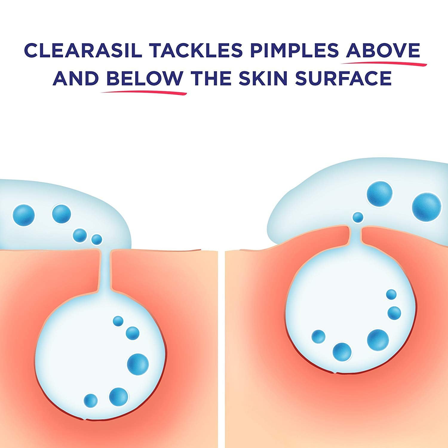 Clearasil Rapid Rescue Deep Treatment Cleansing Pads, 90 Count (Pack of 6)