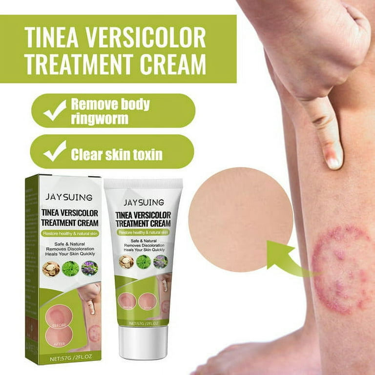 3 Pack Tinea Versicolor Treatment Cream, Antifungal Cream for Tinea  Versicolor & Pedis