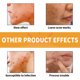 thumbnail image 5 of Fiudx Artículos en oferta con ofertas flash Parche hidrocoloide contorneado para barbilla para imperfecciones y no irritante, apto para veganos, (10 unidades), 5 of 7