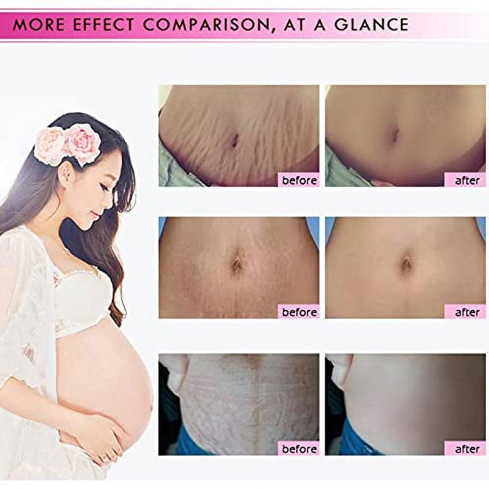 RtopR Mango Stretch Marks and Scar Cream -Stretch Marks and Scar Removal Cream for Pregnancy - Best Body Moisturizer-40g