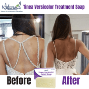 Naturasil 10% Sulfur Medicated Tinea Versicolor Treatment Soap | 4oz Bar