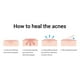 thumbnail image 5 of Tea Tree Acne Pimple Patch Pimple Removal Sticker Parche Para El Cuidado De La Piel ANGGREK AE1013, 5 of 8