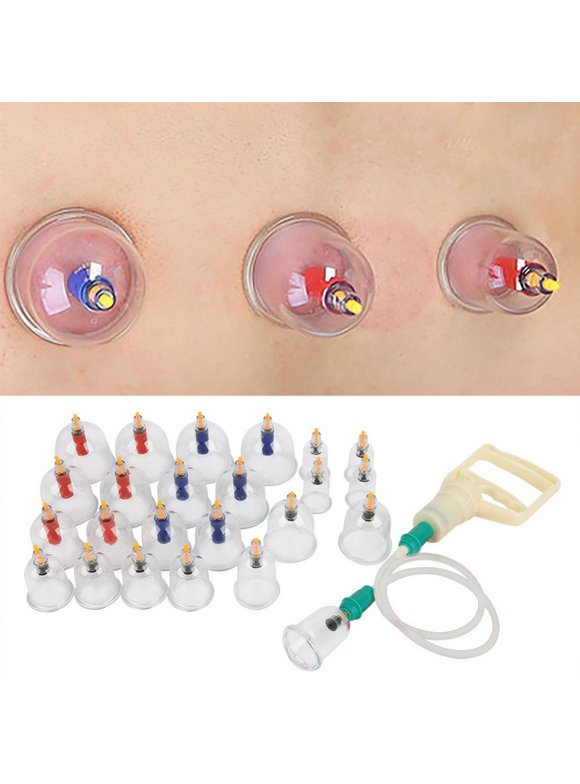 Cupping Therapy in Massage