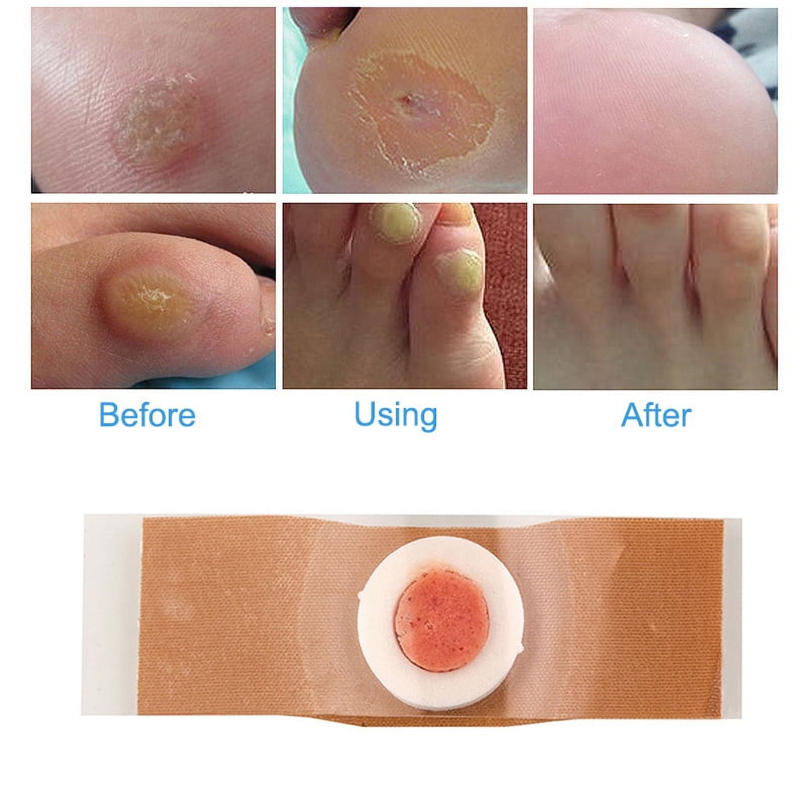 Ikemiter Foot Corn Remover Pads, 12pcs Set, Callus Relief Cushions