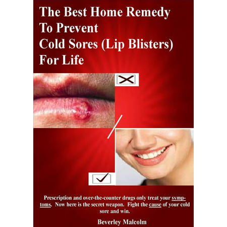 The Best Home Remedy To Prevent Cold Sores (Lip Blisters) For Life - (Best Home Remedy For)
