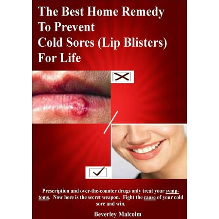 The Best Home Remedy To Prevent Cold Sores (Lip Blisters) For Life - (Best Way To Heal Blister On Bottom Of Foot)