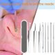 thumbnail image 5 of 5uds remoción de acné de acné Pimple Aguja Blackhead Removedor de tratamiento de acné Tratamiento extractor Tmvgtek Cuidado Belleza, 5 of 9