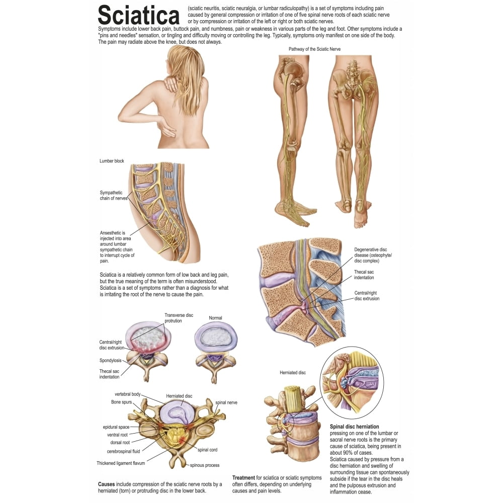 medical-chart-showing-the-signs-and-symptoms-of-sciatica-poster-print