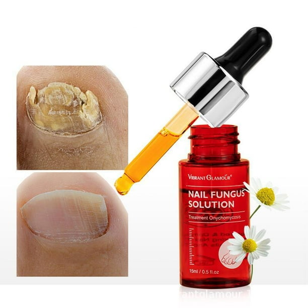 Fungus Nail Treatment Extra Strength Effective Remedy Nail Polish for