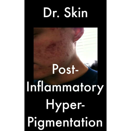 Post Inflammatory Hyperpigmentation - eBook (Best Solution For Hyperpigmentation)