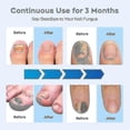 thumbnail image 3 of 2025 Nail Fungus Laser Treatment Device for Multiple Toenail, Home Use 905nm Infrared Light + 470nm Blue Light Toe Nail, 3 of 5