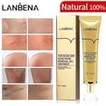 thumbnail image 4 of Crema para eliminar cicatrices de acné, gel para cicatrices, crema facial para reparar manchas de acné, tratamiento para el acné, cuidado de la piel, blanqueamiento de estrías, 4 of 5