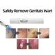 thumbnail image 2 of Lápiz láser para eliminar verrugas genitales Eliminación de verrugas en el ano Condilomas Herramientas de cuidado privado para hombres y mujeres, 2 of 6