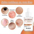 thumbnail image 4 of Milia Remover - Dissolve & Reduce Milia, Whitehead, Sebaceous Hyperplasia - 30ml, 4 of 5