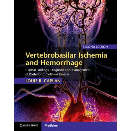 Vertebrobasilar Ischemia and Hemorrhage : Clinical Findings, Diagnosis and Management of Posterior Circulation (Best Way To Improve Circulation)