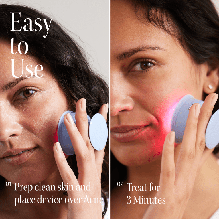 Solawave Bye Acne Spot Treatment, Red & Blue Light Therapy photo 6