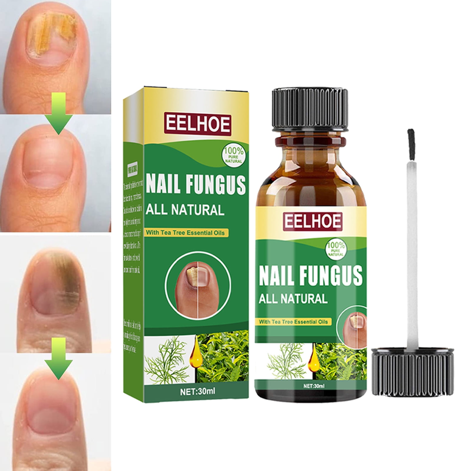 Toenail Fungus Treatment, Effective Nail Fungus Treatment for Toenail