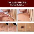 thumbnail image 2 of Eliminador de verrugas Pen Skin Tag Mole Remover Elimina las verrugas de maíz en los pies Hk, 2 of 3