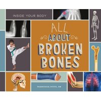 All about Broken Bones