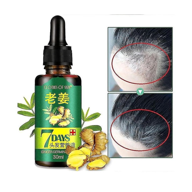 Aceite germinal de jengibre, aceite para el crecimiento del cabello, suero para el crecimiento del cabello, tratamiento para la pérdida de cabello, cuidado del cabello, suero para el crecimiento del cabello, promueve el crecimiento del cabello más grueso-2PCS- Sincero Electrónica