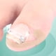 thumbnail image 3 of Kit corrector de uñas encarnadas para uñas curvas, hebilla de armadura de acero inoxidable, herramienta para enderezar uñas encarnadas., 3 of 8