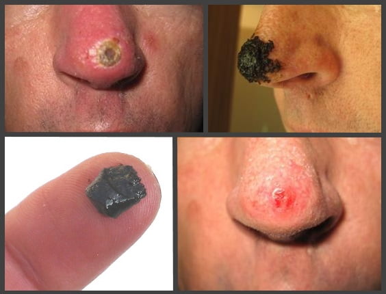 Black Drawing Salve For Splinters And Insect Bites With Charcoal