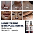 thumbnail image 3 of Vitiligo Removal Spray Moisturize Improve Pigmentation Leukoplakia Anti Melanin Remove Ringworm Lamp White Spots Treatment Spray, 3 of 5