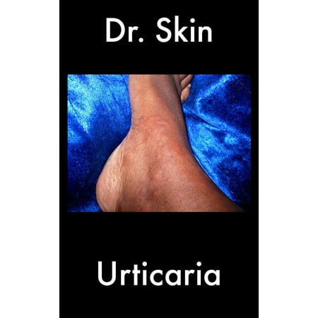 Urticaria - eBook (Best Treatment For Urticaria)