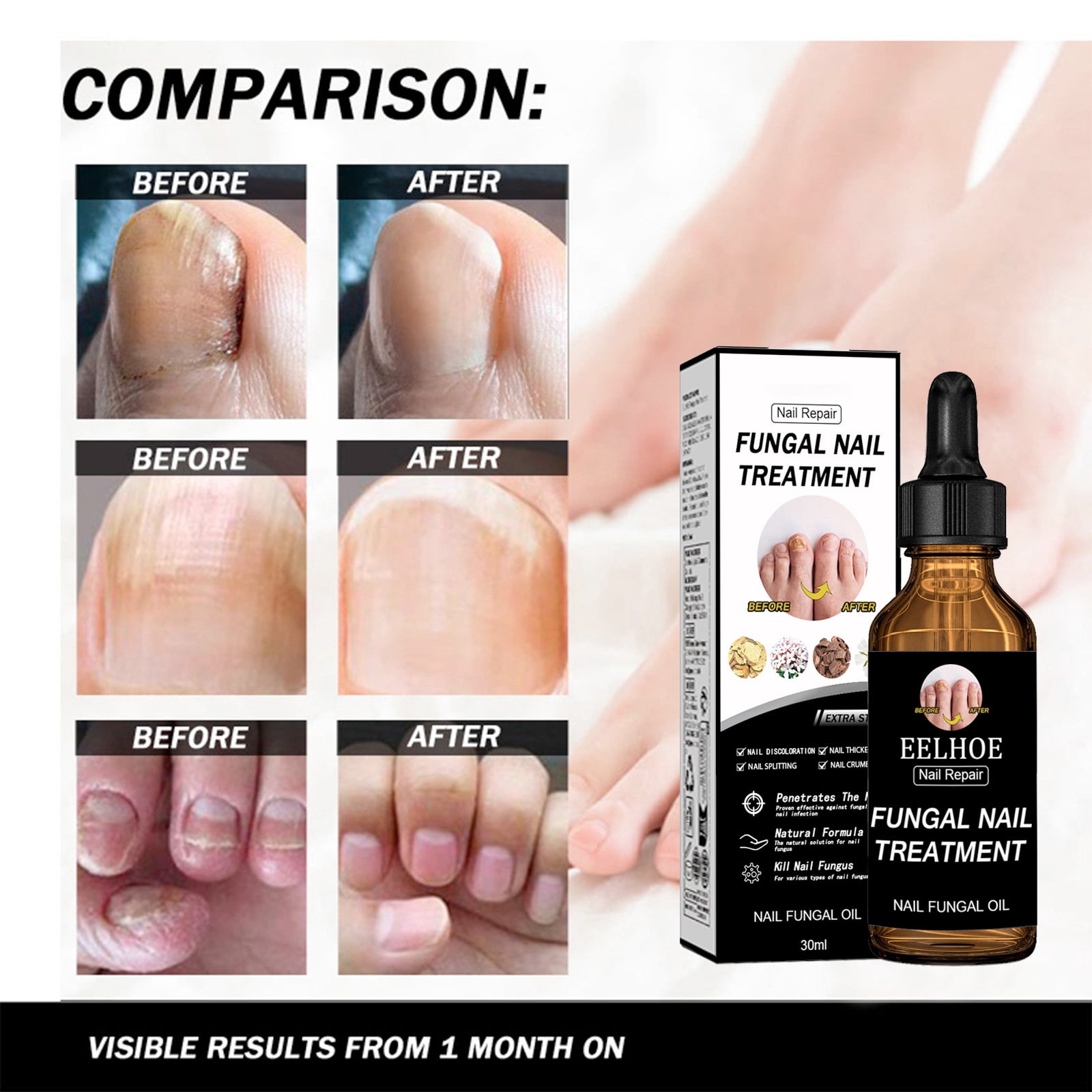 Alvantor Nail Fungus Treatment, Nail Repair Oil Moisturizing and Daily Care, 1fl.oz