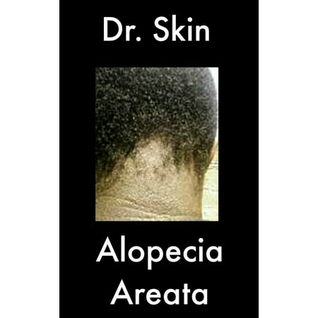 Alopecia Areata - eBook (Best Homeopathy Medicine For Alopecia Areata)