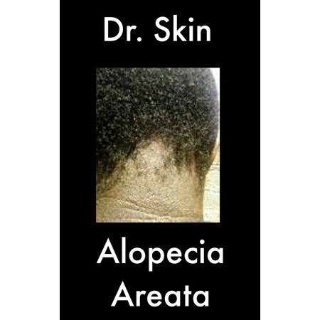 Alopecia Areata - eBook (Best Way To Treat Alopecia Areata)