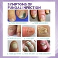 thumbnail image 2 of 2pcs Medinail Nail Fungus Spray Toenail Fungus Treatment, Nail Fungus Treatment For Toenail Gray Nail Repair Spray, 2 of 5