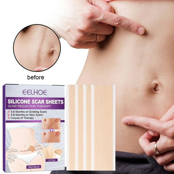 4 hojas de silicona para cicatrices, tiras de gel, parche adhesivo para eliminar cicatrices (75 mm) Ygjytge Cuidado Belleza