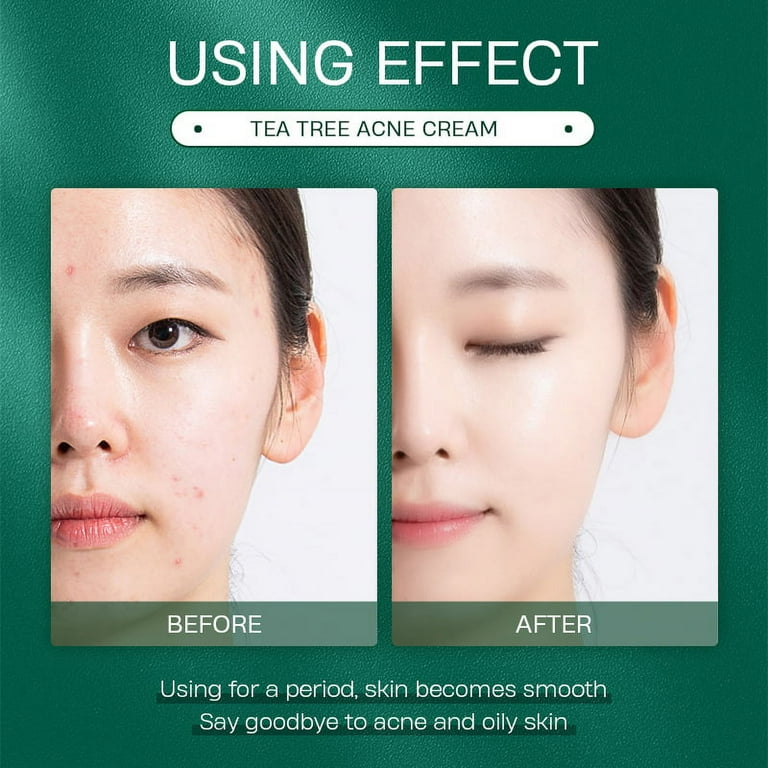 Tea Tree Oil Face Cream Acne Cream for Oily Acne Prone Skin Extra Soothing Nourishing Non Greasy Botanical Facial Moisturizer Acne Removal