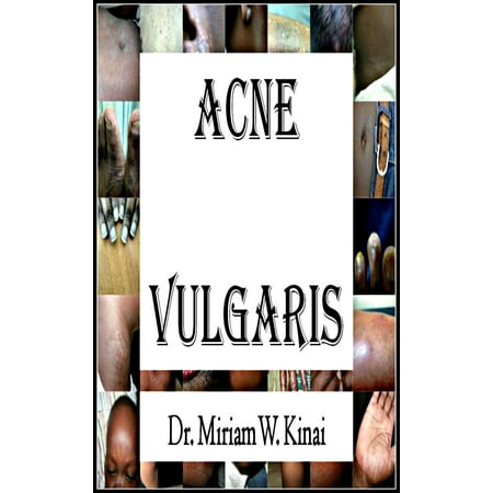 Acne Vulgaris - eBook (Best Treatment For Acne Vulgaris)