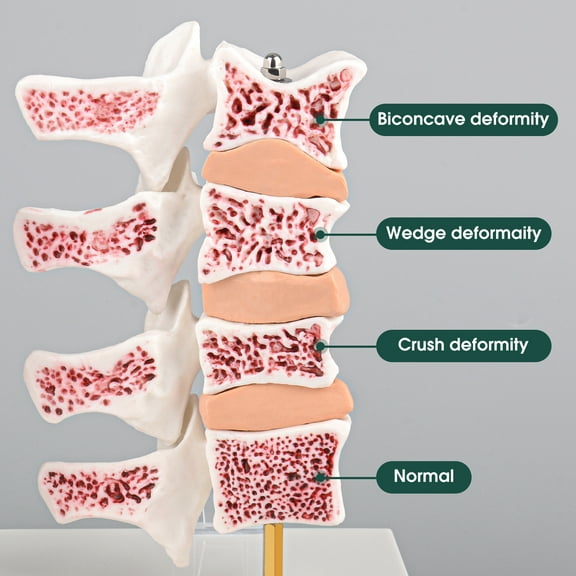 Eztrain Osteoporosis Model, Human Vertebrae Anatomical Model for Teaching Demonstration