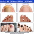 thumbnail image 5 of 2024-64pcs Nail Fungus Plasters, Toenail Treatment For Intensive Nail Fungus Treatment, Quick And Effective Nail Repair For Damaged Nails And Appearan, 5 of 5