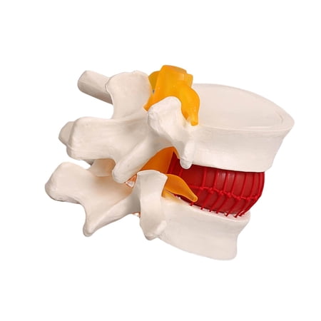 Spinal Disc Herniation Model Lumbar Cervical Removable Nucleus Pulposus Fiber Ring Orthopedic Teaching Aid