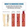 thumbnail image 4 of Venoheal Varicose Vein Ease Paste, Varicose Veins Paste, Varicose And Spider Veins Ease For Legs, Improve Blood Circulatio, 4 of 5